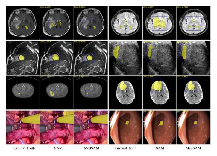 MedSAM: A New Tool for Medical Image Segmentation — illustration